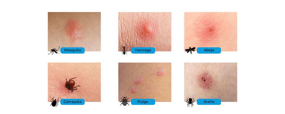 distingue las picaduras de insectos como mosquitos y chinches gracias a estas imágenes