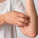 Articulo sobre la mejor crema para la psoriasis para la piel seca