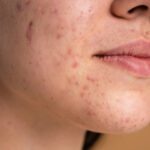 Eliminar marcas acné: trucos infalibles