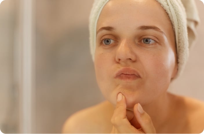 Adiós marcas de acné: ¡Recupera tu piel!