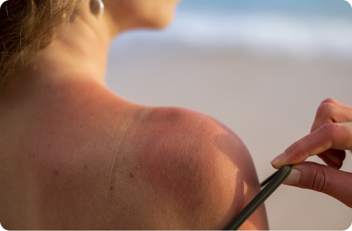 ¡Alergia Solar! Proteje tu piellar: síntomas y cuidados